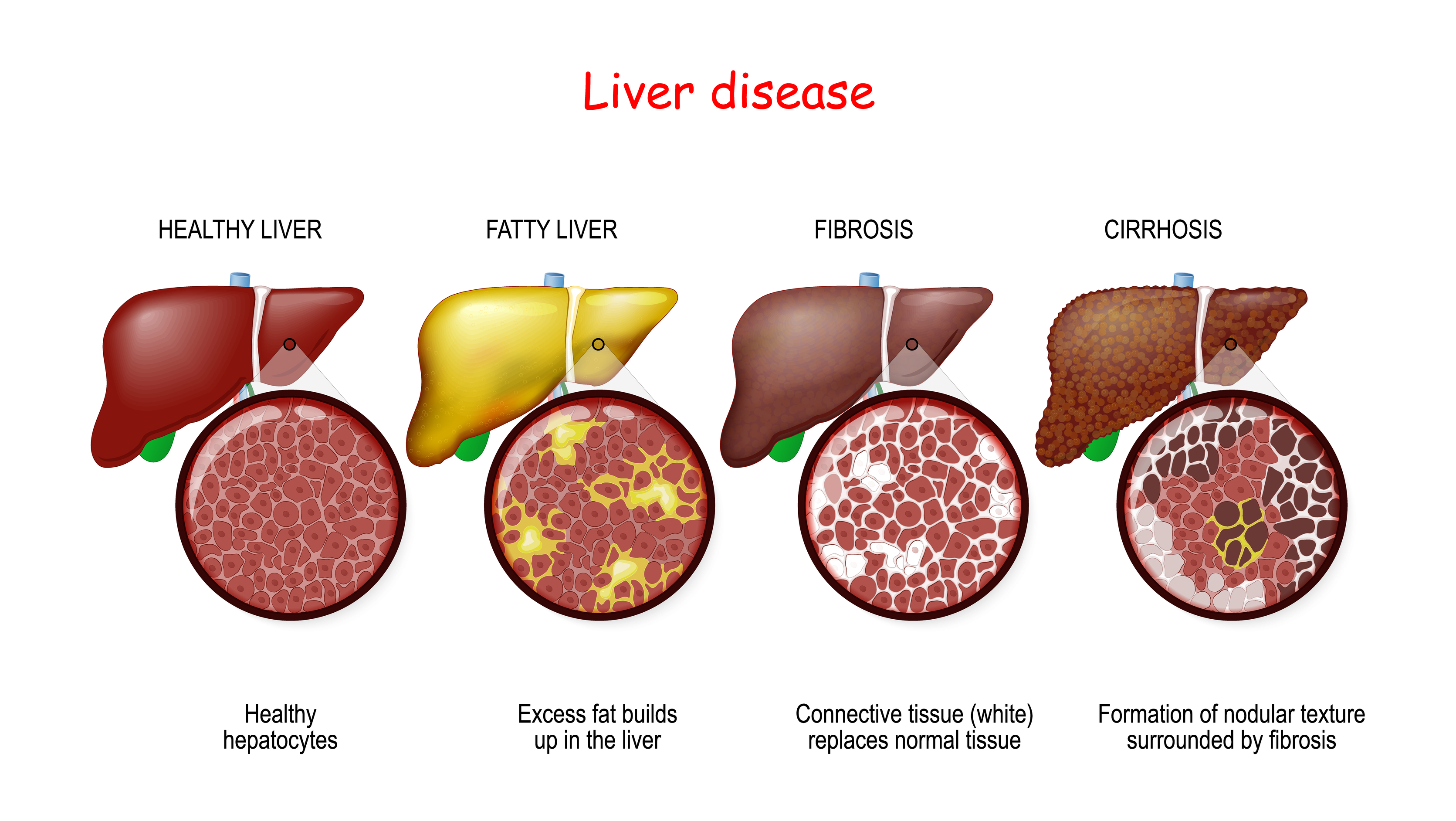 Liver Disease - Katy, TX|Premier Gastroenterology